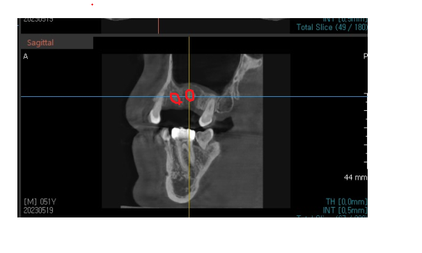 고덕동 치과 잇몸 주저앉음 느낌이 들었다면 늦었을 수도 있습니다. 관련 이미지 8