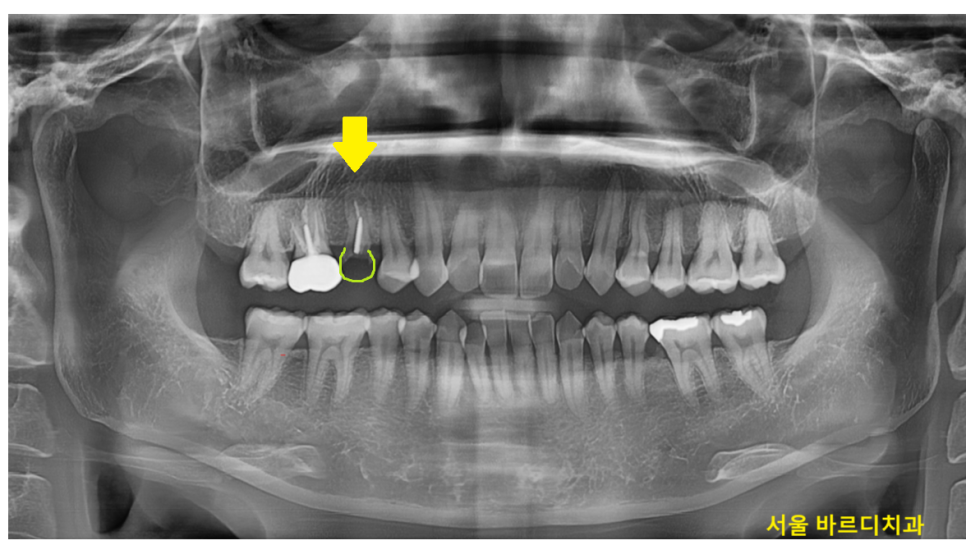 씌운 치아 부러짐 뿌리만 남은 경우 임플란트로 수복하기 관련 이미지 2