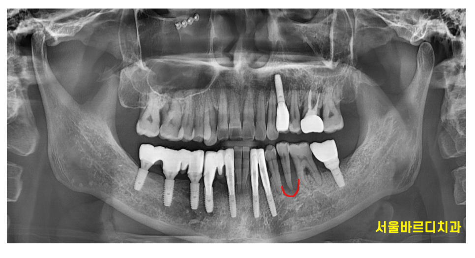 강동구 뼈이식 임플란트 과잉이라 생각하실 수 있지만 진실은 관련 이미지 3