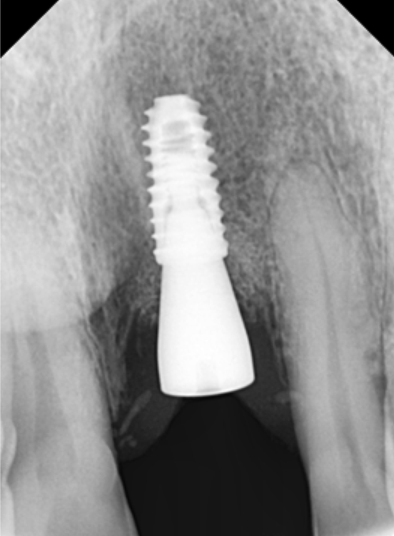 고덕동치과 서울바르디치과 전치부 및 구치부 임플란트 치료증례 #9 관련 이미지 5