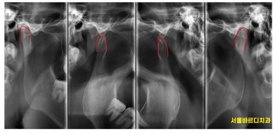 둔촌동 치과 턱 통증 귀 밑 아픔 턱관절 장애를 의심하세요!! 관련 이미지 2