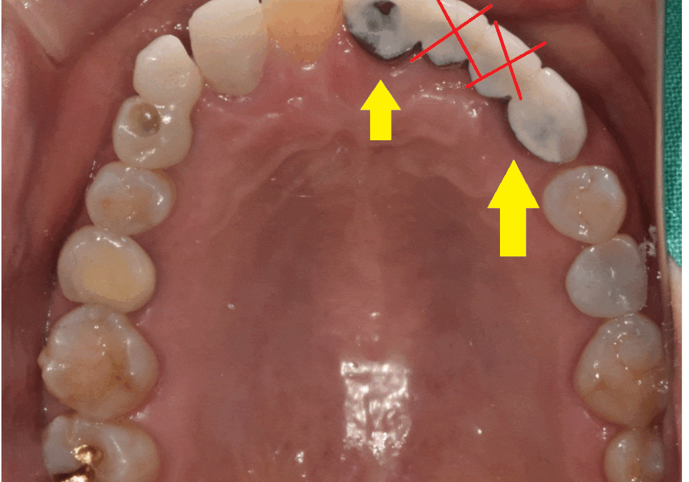 길동 치과 임플란트 수술 대안은 없을까요???? 관련 이미지 1