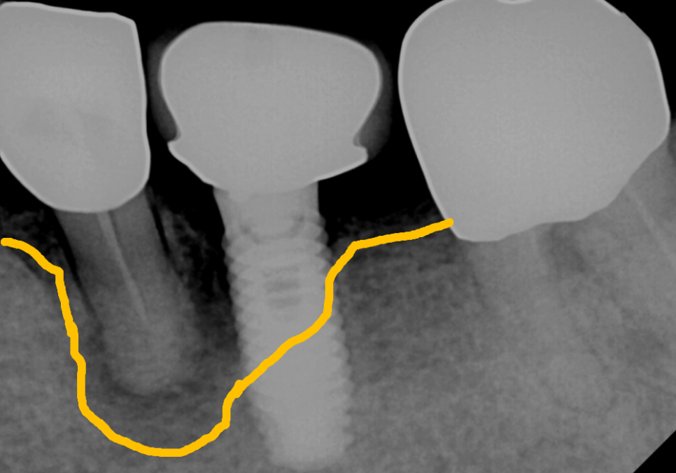 상일역 임플란트, 음식물 끼는 이유, 처음엔 안 그랬는데 왜 점점 심해지는 걸까요? 관련 이미지 7
