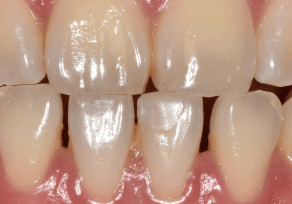 앞니 라미네이트, 치아 시림 고민 덜 수 있는 해결 방법 공개합니다. 관련 이미지 4