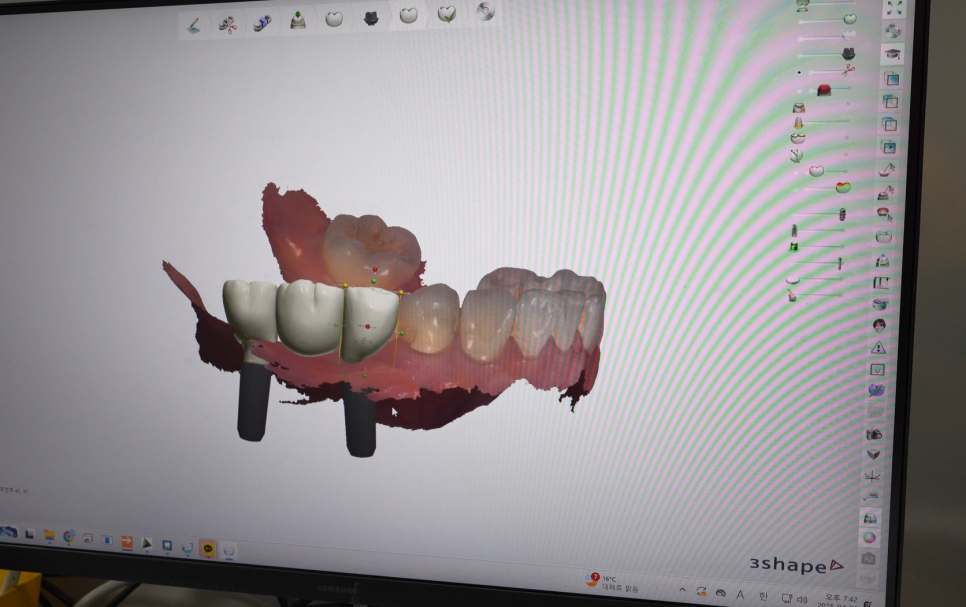 치아 사이 충치 원데이 인레이 하루만에 끝낼 수가 있을까? 관련 이미지 4