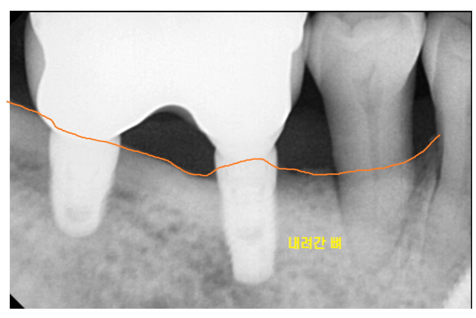 덕소 치과 발치 후 당일 뼈이식의 중요성 설명드립니다!! 관련 이미지 4