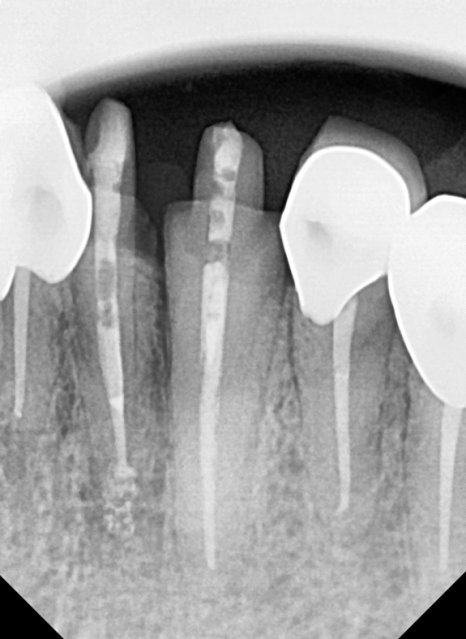 앞니 음식물 끼임, 왜 젊을 때보다 더 자주 발생하는 걸까요? 까맣게 변한 앞니 치료 사례 관련 이미지 13