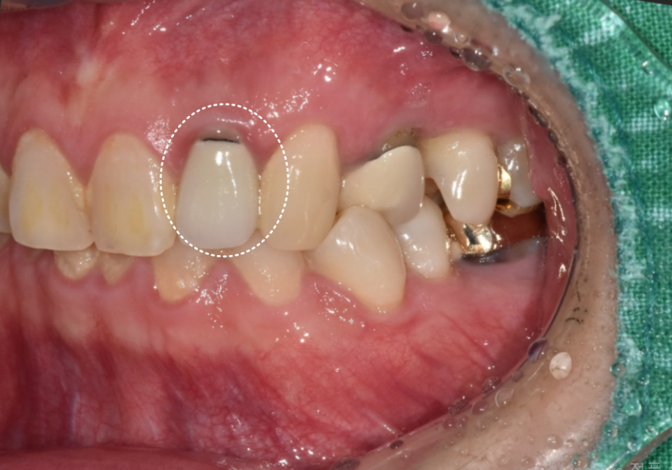 강동구 재신경치료, 왜 첫 치료보다 성공률이 낮다고 할까요? 관련 이미지 4