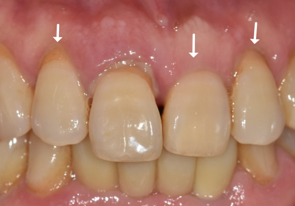 앞니 길어짐, 위 앞니가 점점 내려온다면? 관련 이미지 9