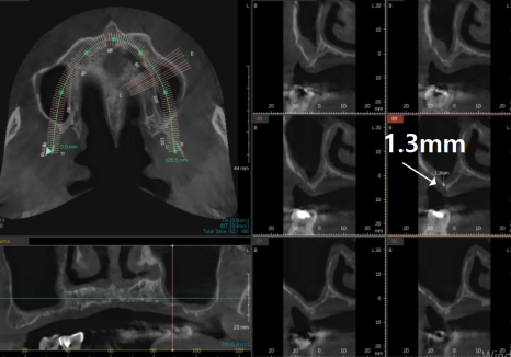 뼈가 없어서 안 된다구요? 70대 당뇨 무치악 환자분의 전체 임플란트 사례 관련 이미지 8