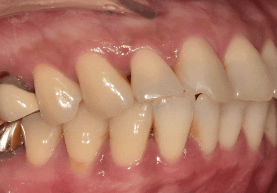 깨진 앞니 심미 치료, 라미네이트 vs 지르코니아 어떤 선택이 더 나을까? 관련 이미지 5