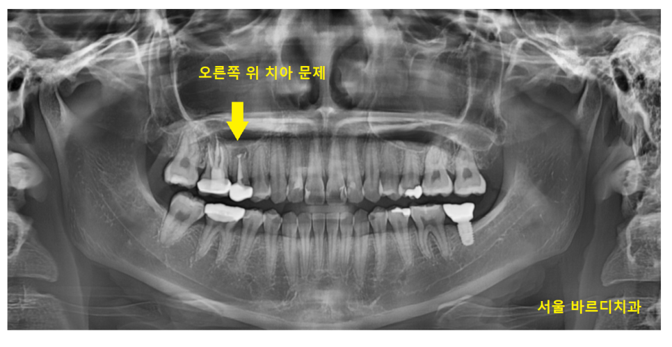 망월동 치과 재신경치료 자연치아 살리기 끝판왕 치료 mta로 가능했습니다. 관련 이미지 2