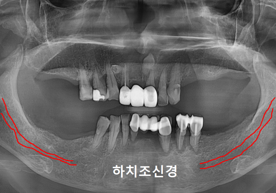 천호 디지털 가이드 임플란트, 일반 임플란트와 무슨 차이가 있나요? 관련 이미지 7