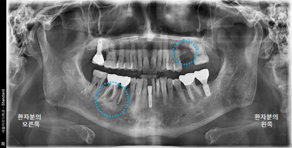 서울바르디치과 상하악 대구치 네비게이션 임플란트 치료증례 #4 관련 이미지 2