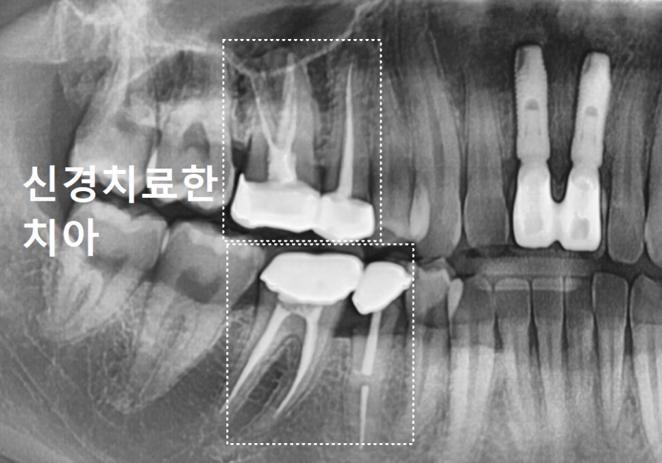 명일동 치과, 잇몸이 검게 변했다면? 앞니 변색 원인은 바로 관련 이미지 5