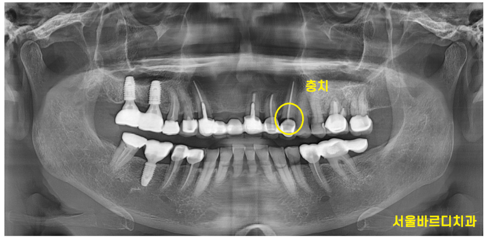 상일동 치과 충치로 인한 앞니 브릿지 파절 재건해보았습니다. 관련 이미지 3