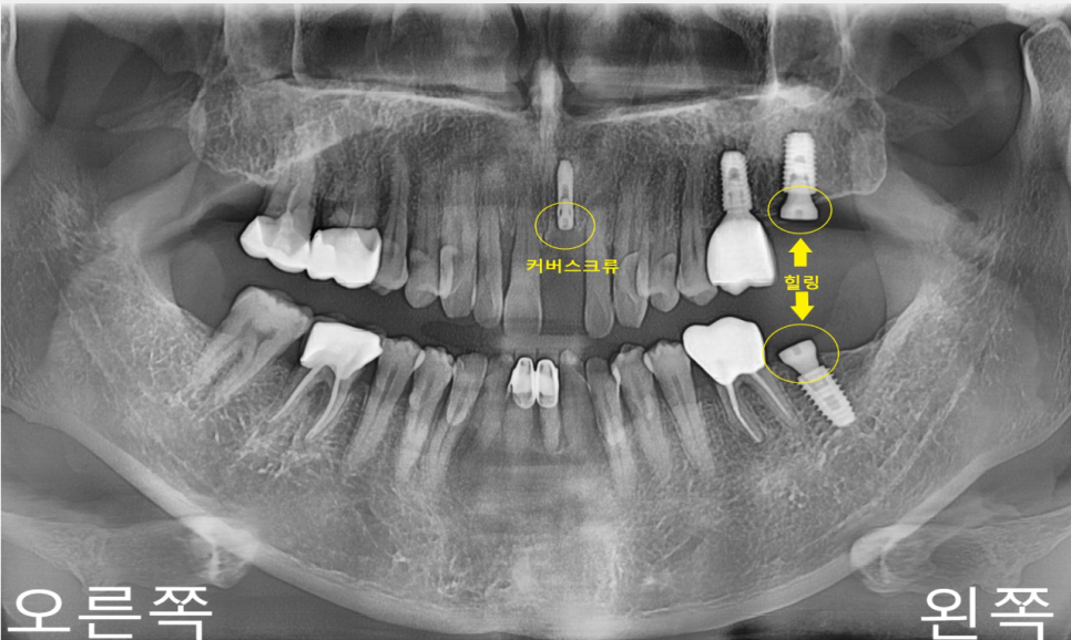 상일동치과 서울바르디치과 무절개 네비게이션 임플란트 치료증례 #3 관련 이미지 5