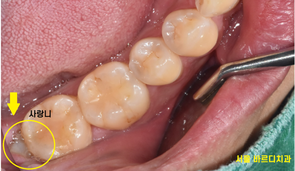 상일동 사랑니 맨날 뽑아야지는 그만!! 매복 치아도 깔끔하게 뽑으세요 관련 이미지 4
