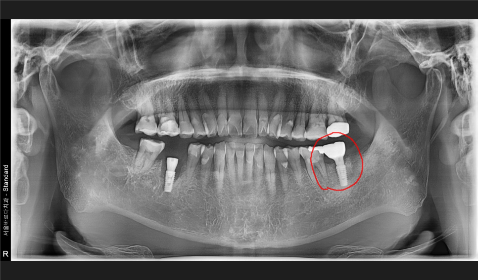 바르디 임플란트는 바르게 심지만, 빠르게 씹습니다. 그간의 경험을 바탕으로요. 관련 이미지 14