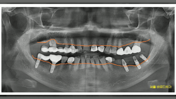망월동 치과  양쪽 어금니 문제가 있을때 치료 순서는? 관련 이미지 1