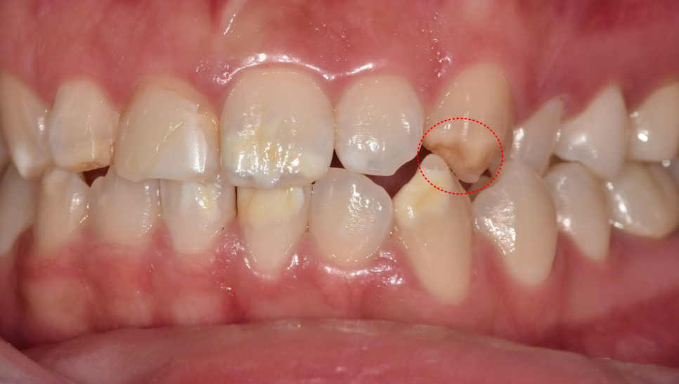 강동구 라미네이트, 치아 하얀 반점 없애고 싶다면? 치료 방법 관련 이미지 4