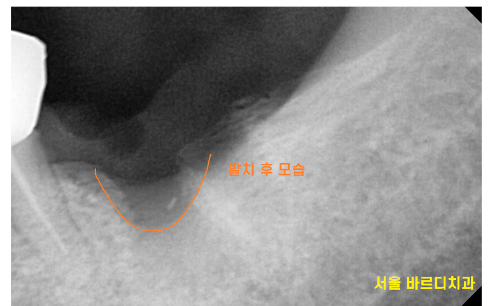 천호동 임플란트 치아 뿌리 충치가 파절을 유발하다. 관련 이미지 7