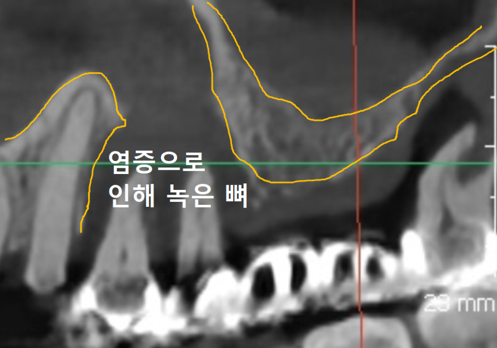 편측 저작, 한쪽으로만 식사하면 결국 이렇게 됩니다. 관련 이미지 9