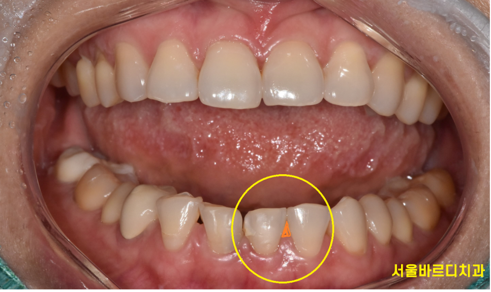 고덕동 치과에서 시행한 라미네이트와 치아 미백 과정 및 순서 관련 이미지 4