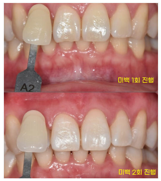 상일동 치아미백 가격, 횟수 궁금하신 부분 싹 정리했습니다. 관련 이미지 5