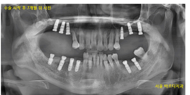 길동 치과 임플란트 뼈이식 후 흡연 상관 있을까? 관련 이미지 1