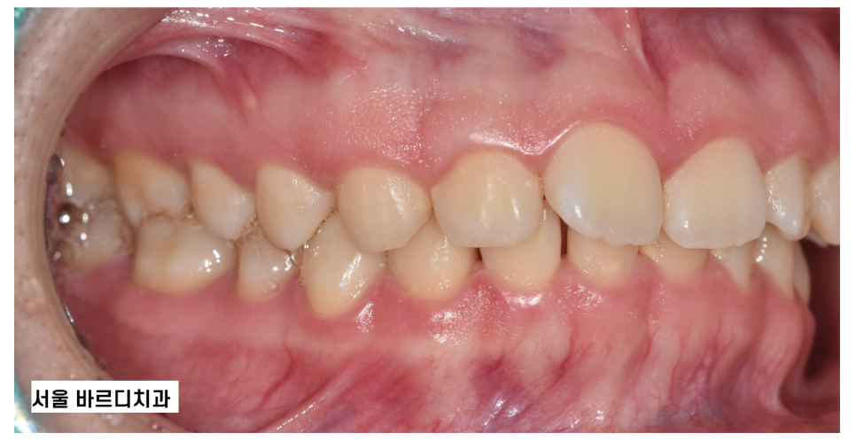 치아교정 턱관절 연관이 있기에 고덕역 치과에서는 이렇게 합니다. 관련 이미지 2