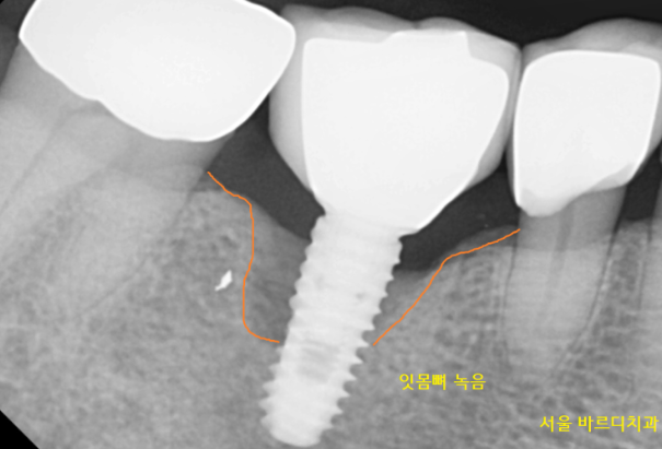 풍산동 치과 임플란트 염증으로 교체 한 환자분 케이스 관련 이미지 4