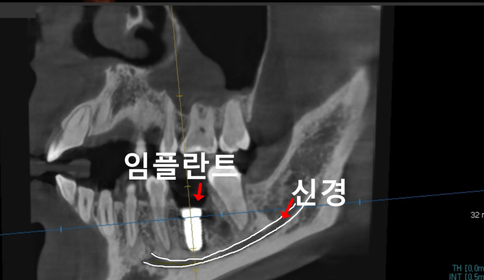 고덕동 20대 임플란트, 시기 놓치면 비용 2배 이상 듭니다. 관련 이미지 9