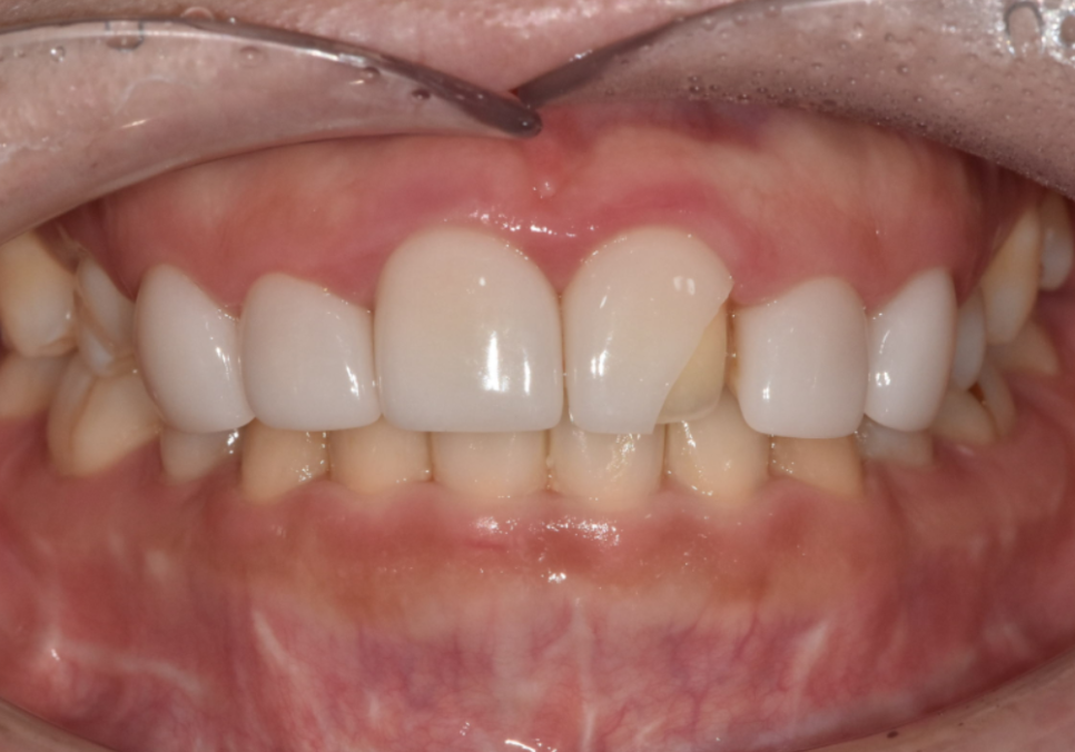 천호 라미네이트 파절 탈락, 줄이려면 치과 선택이 중요합니다. 관련 이미지 7