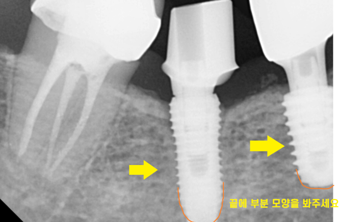 타치과 임플란트 as 수리 가능한 선동치과 관련 이미지 7