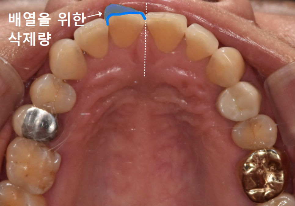 깨진 앞니 심미 치료, 라미네이트 vs 지르코니아 어떤 선택이 더 나을까? 관련 이미지 8