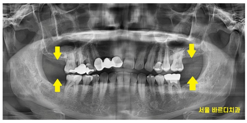 명일동 치과 임플란트 위아래 같이 할 수 있나요?? 관련 이미지 1