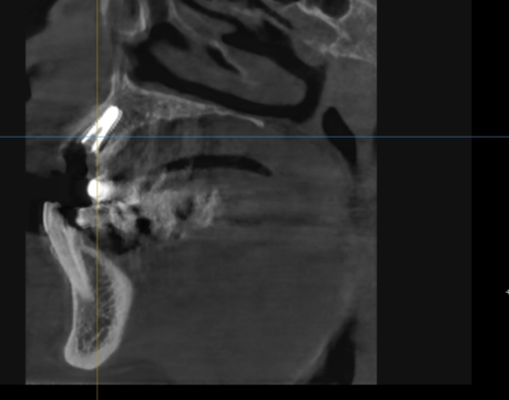 앞니 고름, 잇몸약을 먹어도 왜 염증이 가라앉지 않을까요? 관련 이미지 11