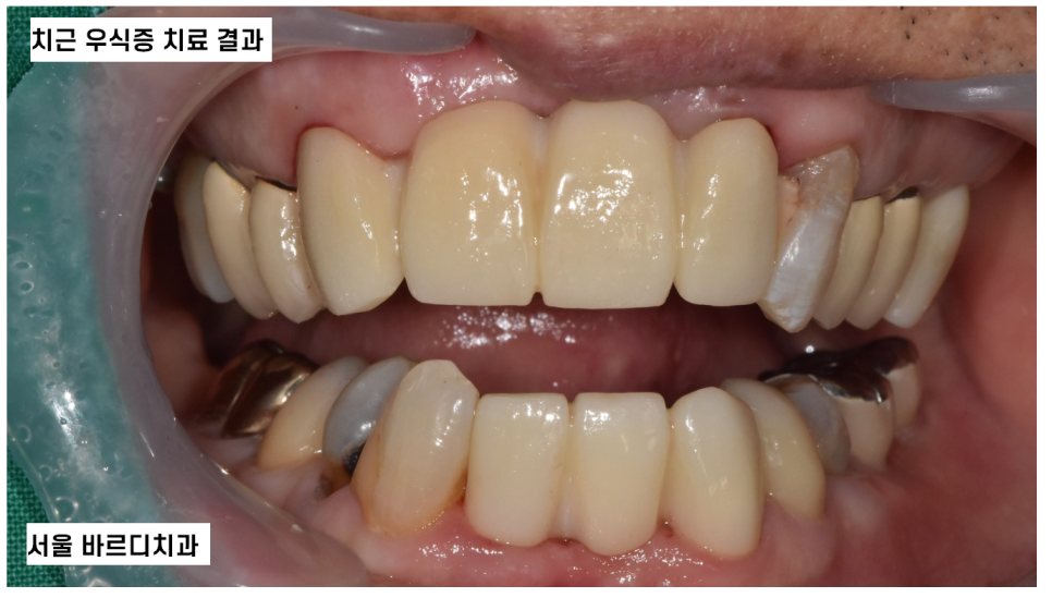 입 마름 치근 우식증이 쉽게 생길 수 있습니다!! 관련 이미지 7