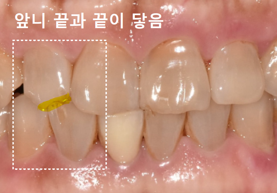 앞니 깨짐 치료 비용, 더이상 치과에 돈 낭비하기 싫다면? 깨지는 원인부터 알아야 합니다. 관련 이미지 12