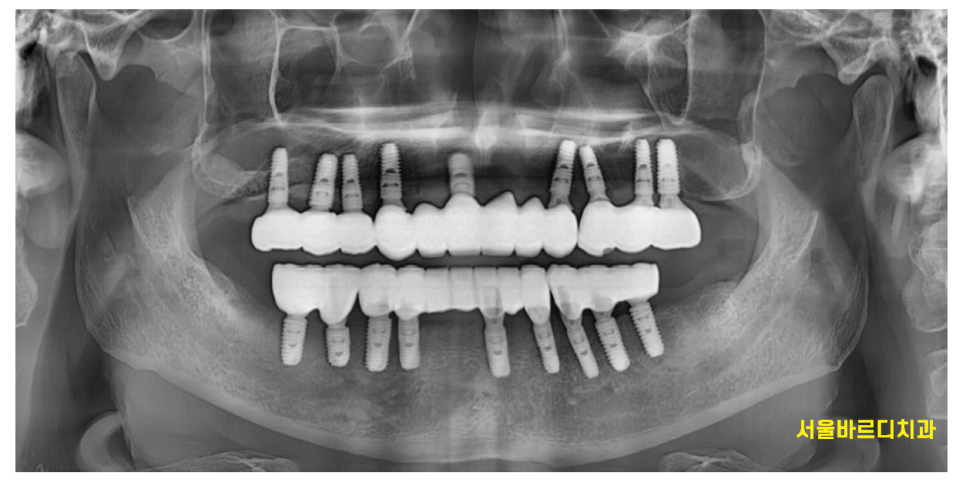틀니 쓰다가 임플란트 어려움은 ? 높이를 높여주는게 킥!!! 관련 이미지 6