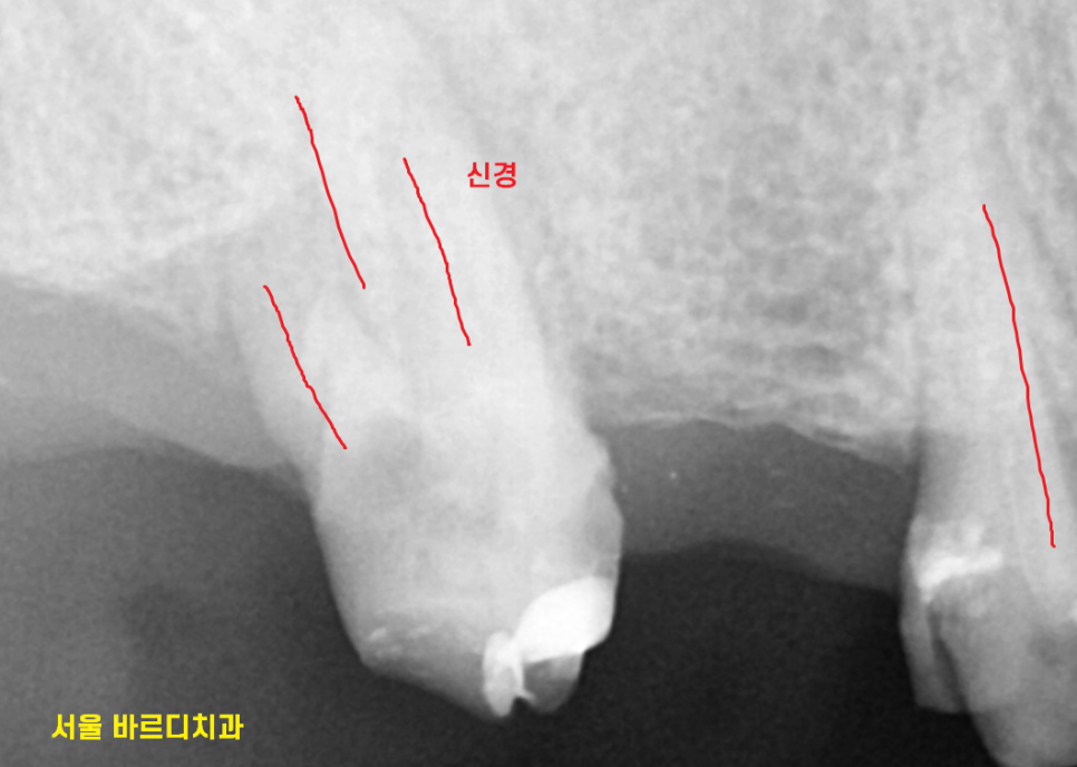 풍산동 치과 임플란트 시술후 통증 부작용은 아닐까? 관련 이미지 5