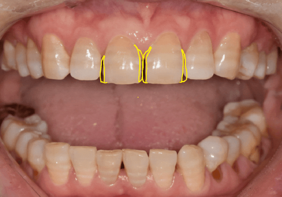 50대 라미네이트, 앞니 벌어짐과 변색 고민 이렇게 해결했습니다. 관련 이미지 3
