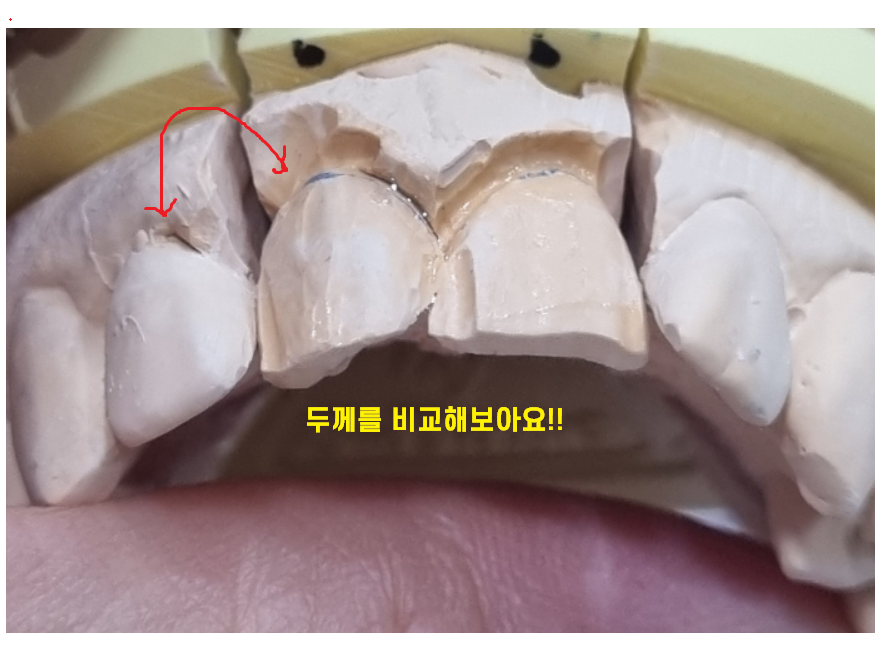 상일동 라미네이트 과연 진짜 안좋을까??? 교정, 크라운과 비교해보았습니다!! 관련 이미지 2