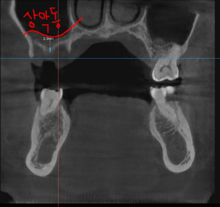 망월동 치과 염증이 심하면 임플란트 바로 못심어요 잇몸뼈 함몰 케이스 관련 이미지 7