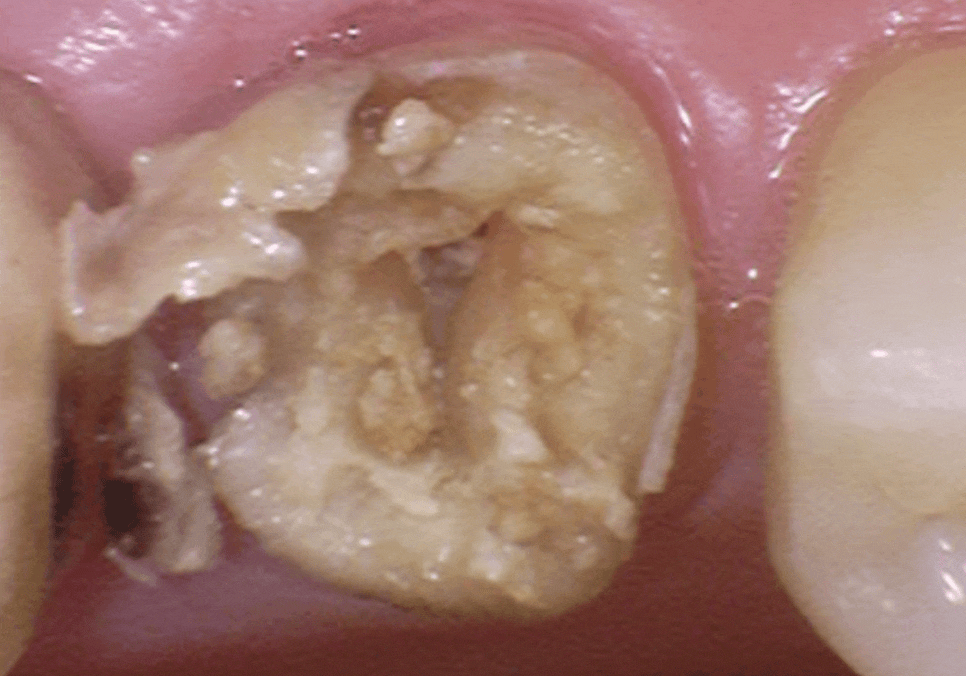 상일역 치과, 오래된 금니 빠짐, 같은 증상으로 내원했지만 전혀 다른 결과, 그 차이는? 관련 이미지 4