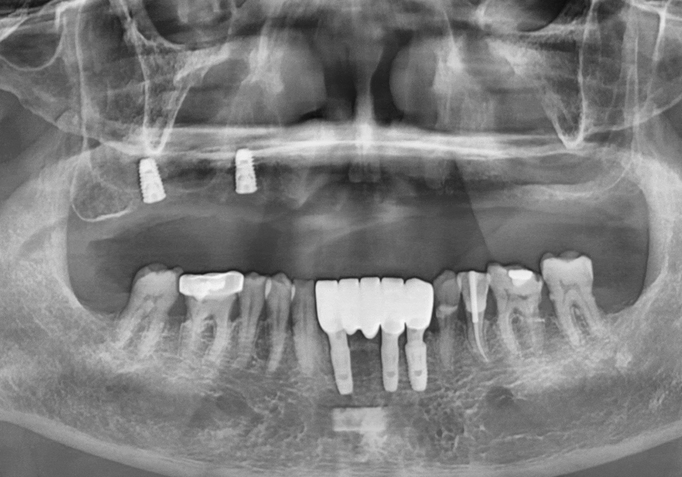뼈가 없어서 안 된다구요? 70대 당뇨 무치악 환자분의 전체 임플란트 사례 관련 이미지 9