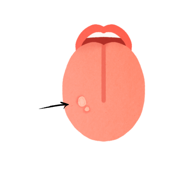 치아교정 중 발생하는 구내염 왜 발생할까? 관련 이미지 1