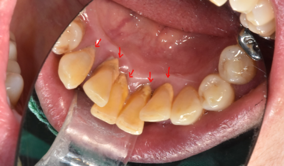 아래 앞니 임플란트 잇몸 염증 고름으로 인한 흔들림이 심해질때 관련 이미지 7