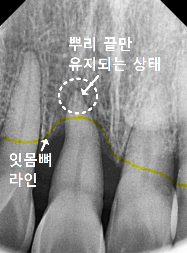 앞니 길어짐, 위 앞니가 점점 내려온다면? 관련 이미지 7